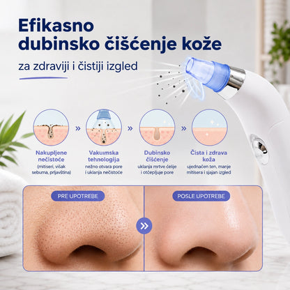 Vakumski aparat za dubinsko čišćenje lica